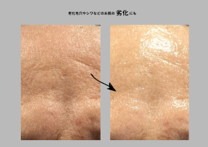 ピーリング＝「剥ける」時代ではなくなりました！